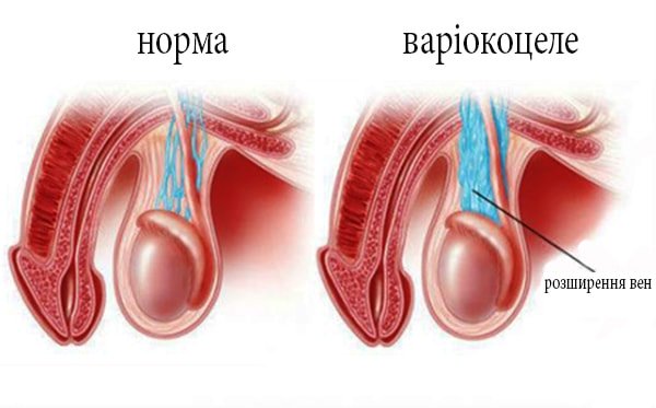 Варіокоцеле