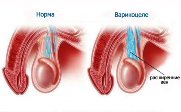 Варикоцеле