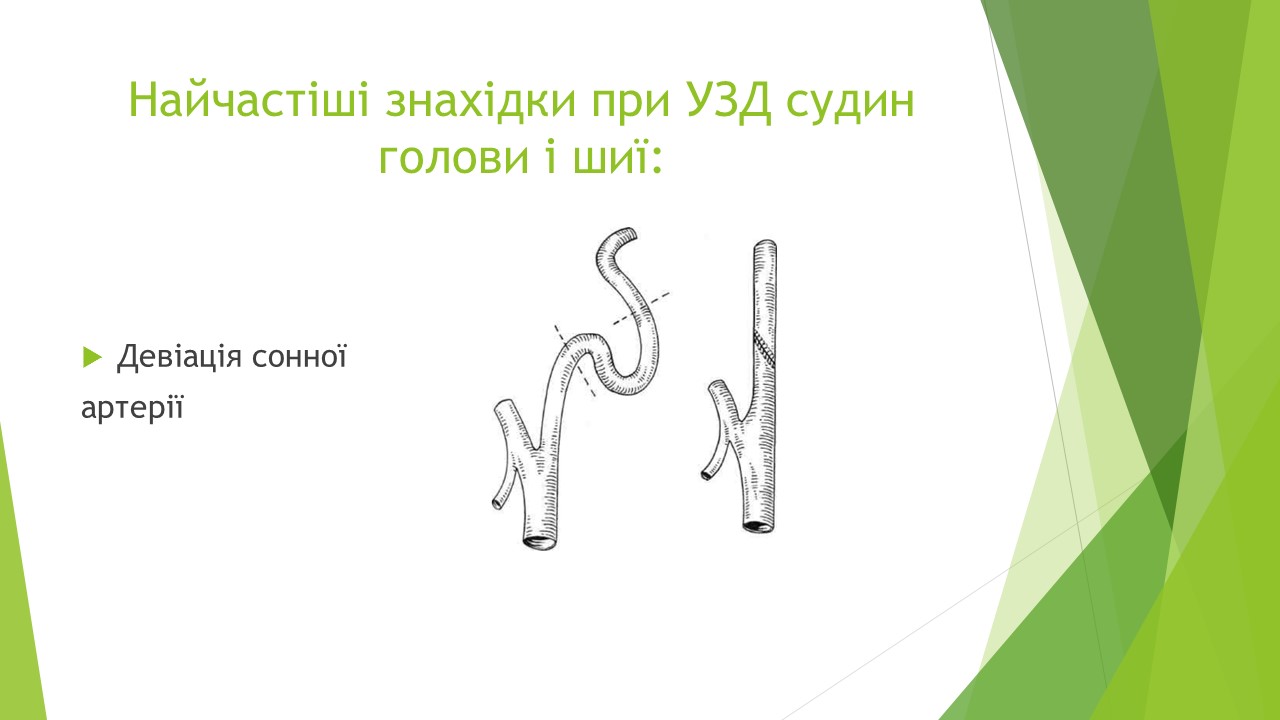 Слайд з презентації "Найчастіші знахідки при УЗД судин голови і шиї".