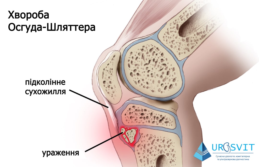 Причини виникнення хвороби Осгуда-Шляттера.