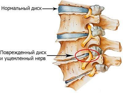 Для чого потрібна КТ грудного відділу хребта?