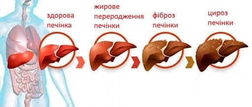 Що таке еластографія та еластометрія?