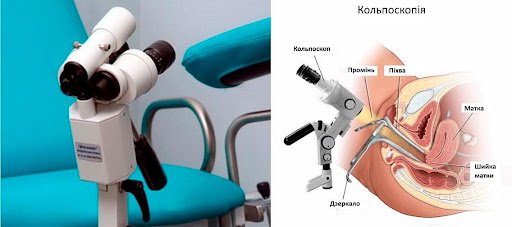 Кольпоскопія