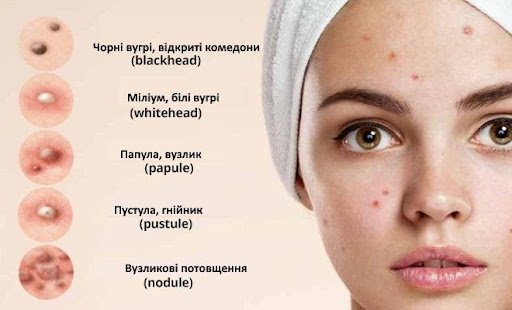 Як вже стало зрозуміло, акне – це сальна залоза, яка закупорилася. Вони бувають різні: