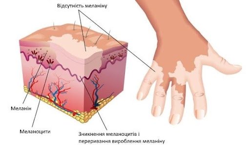 Що таке вітиліго?