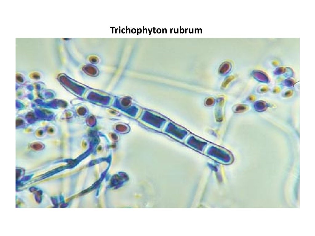Trichophyton rubrum.