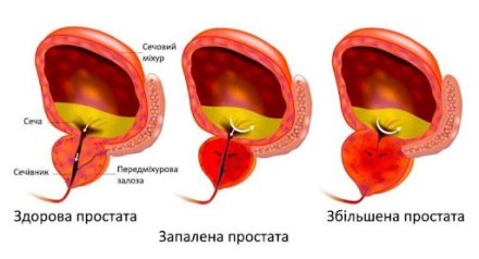 Причини простатиту.