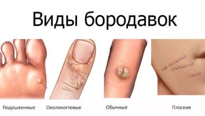 Види бородавок.