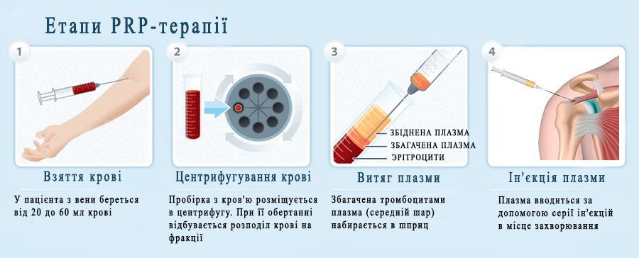 Опис процедури плазмоліфтингу статевого члена у чоловіків.