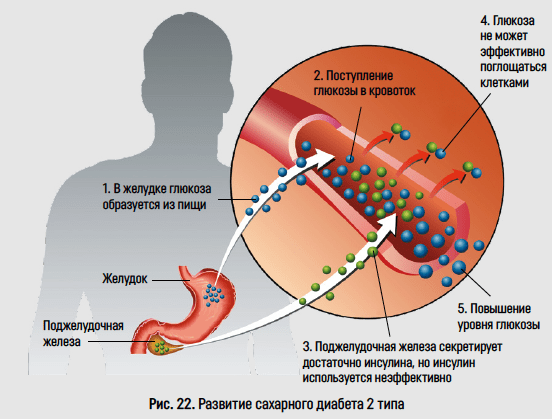 Цукровий діабет ІІ типу.