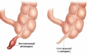 Гострий апендицит-2.