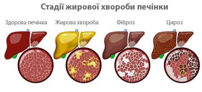 Неалкогольна жирова хвороба печінки-2.
