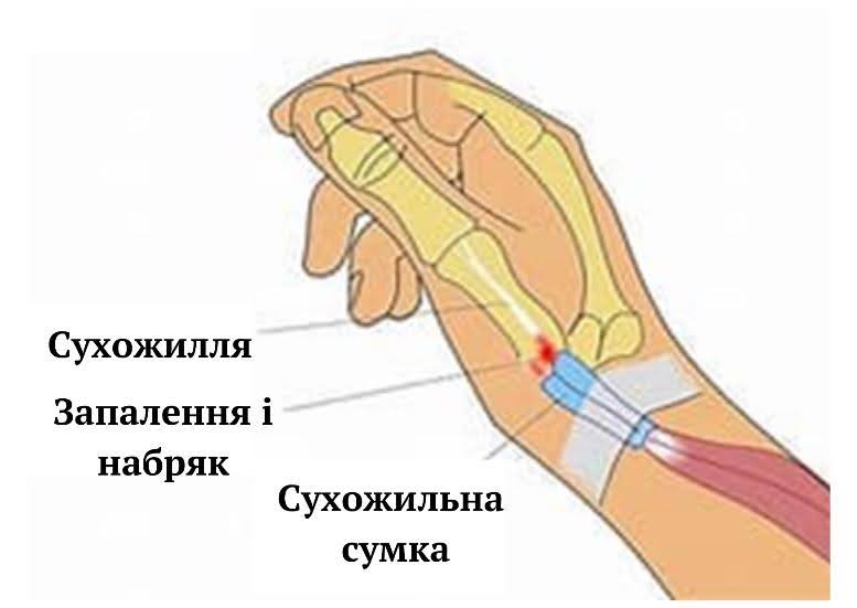 Що таке тендиноз?