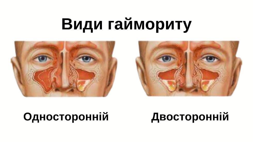 За розташуванням вогнища запалення.