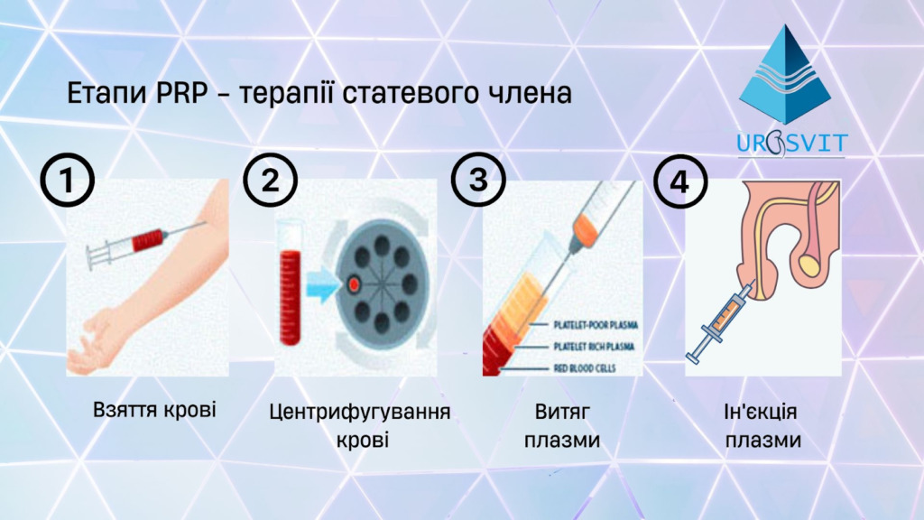 Плазмотерапії статевого члена: як відбувається процедура.