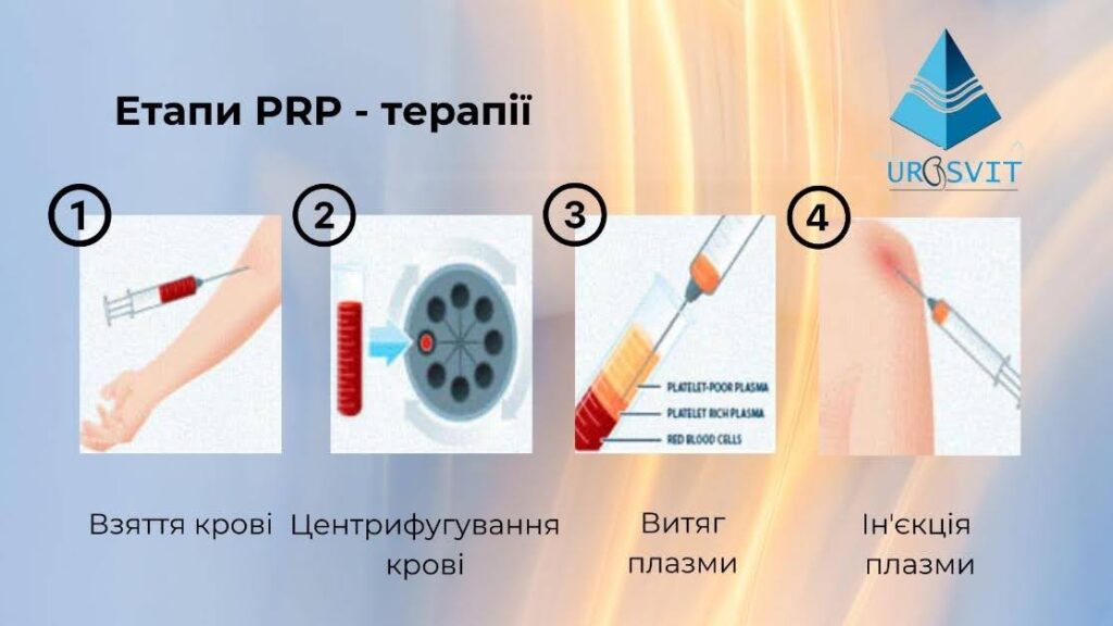 Етапи PRP-терапії.