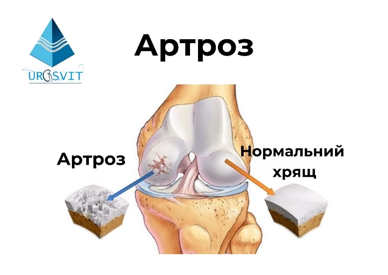 Що таке артроз?