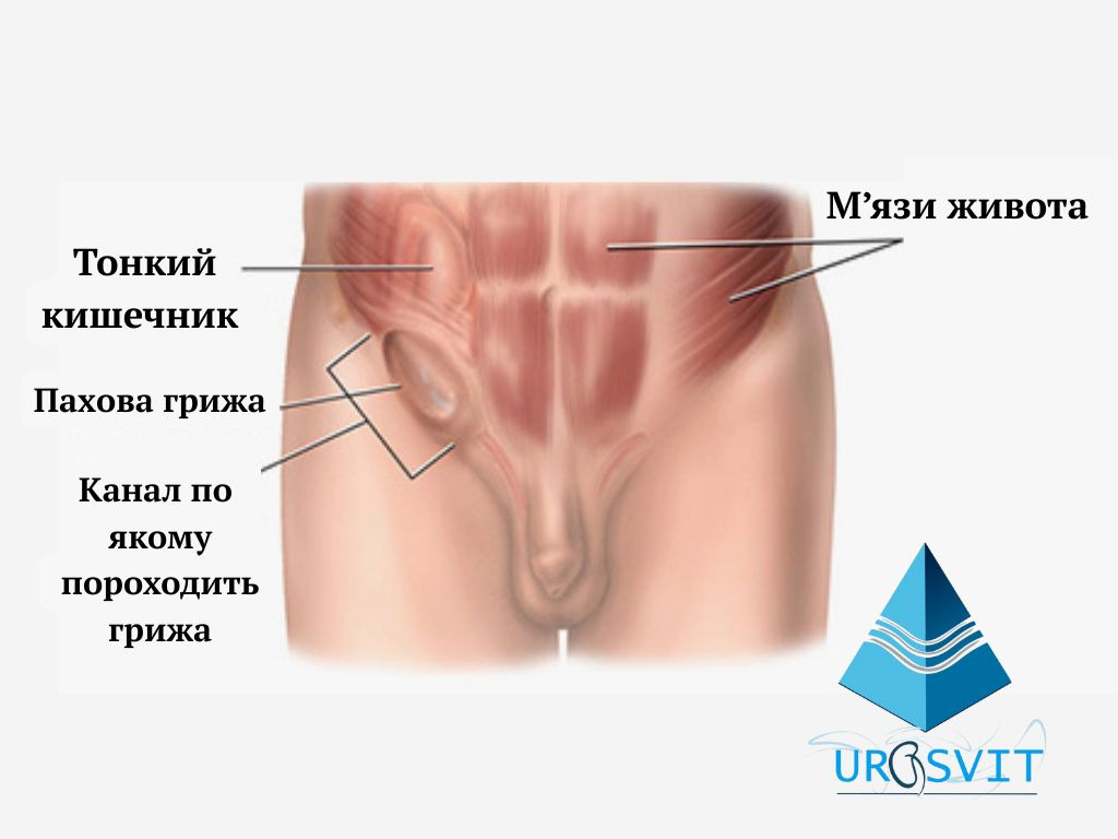Пахова грижа: симптоми, діагностика та лікування