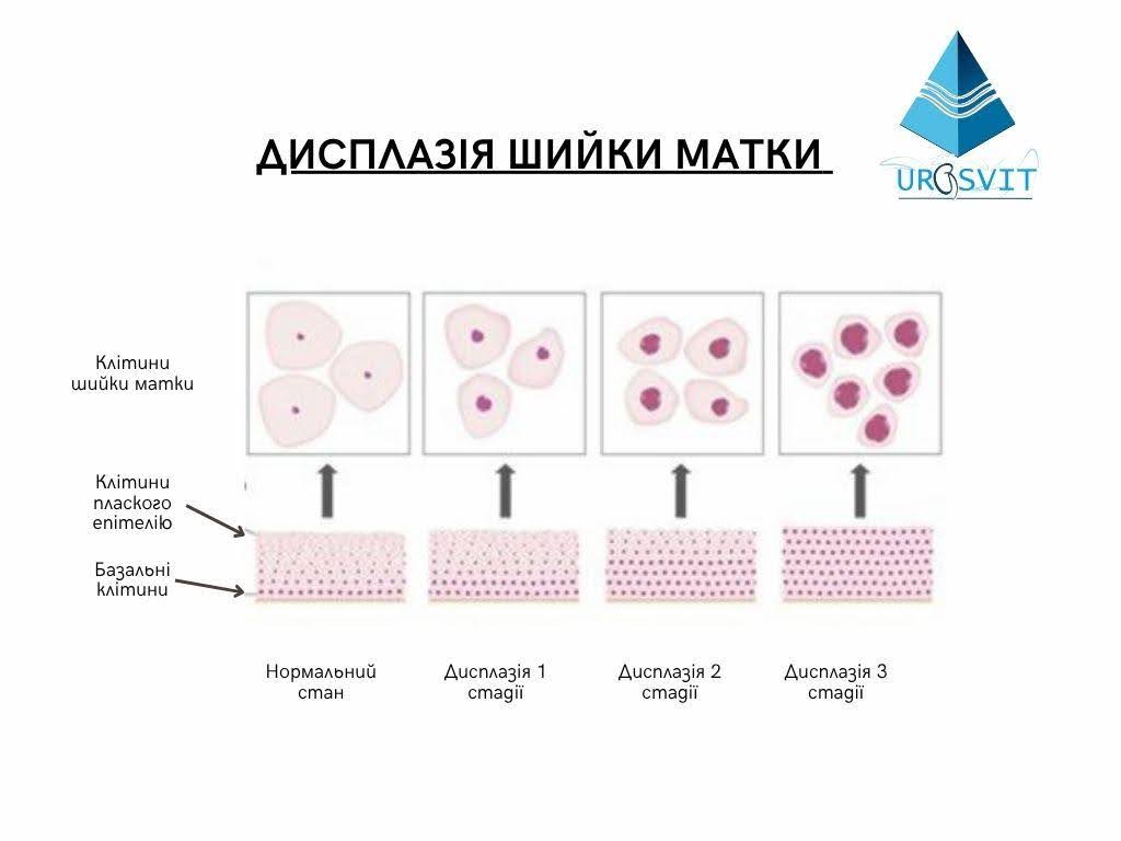 Стадії дисплазії шийки матки.