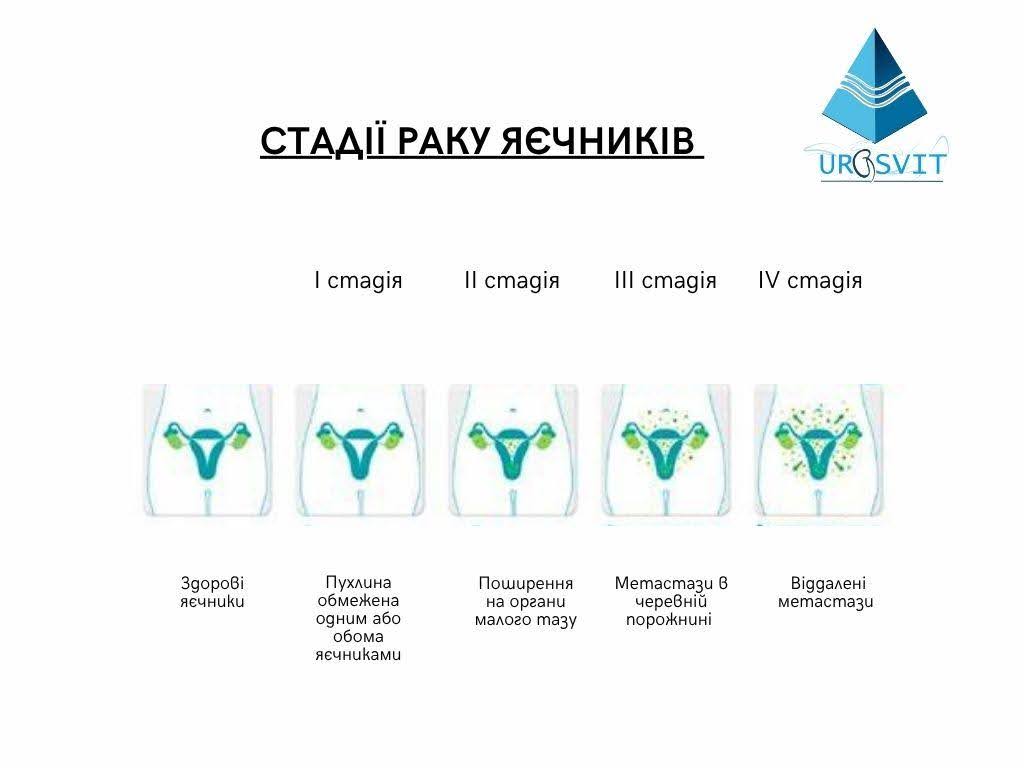 Стадії раку яєчників.