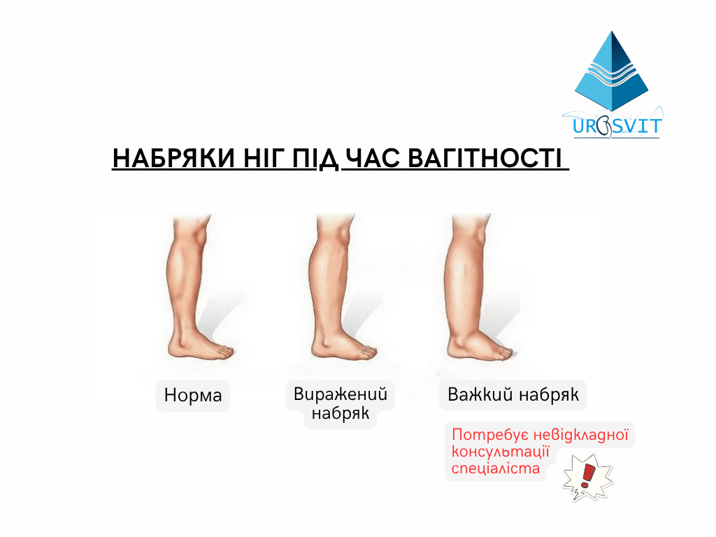 У чому небезпека набряклості ніг?