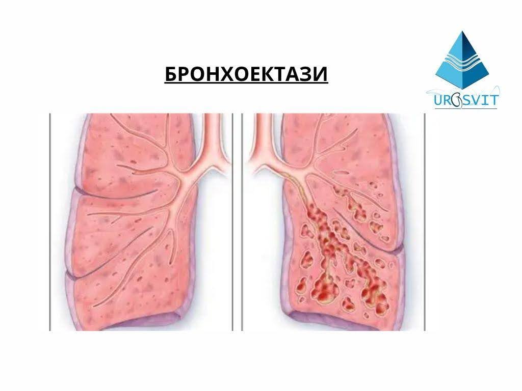 Що таке бронхоектази.