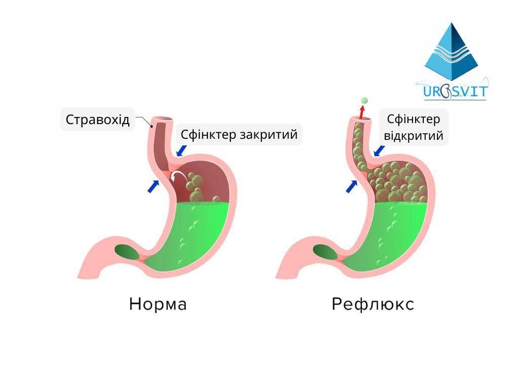 Основные причины появления изжоги.