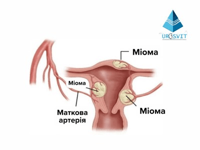 Что такое миома матки.
